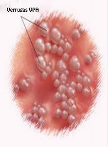 hpv en mujeres como se detecta trace papillomavirus frottis